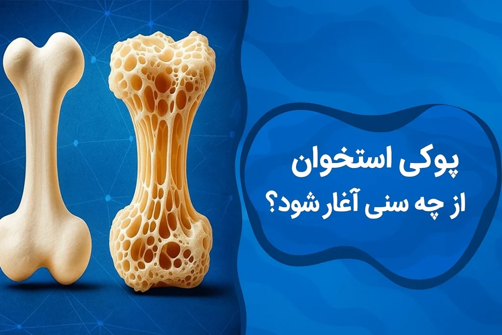 پوکی استخوان از چه سنی آغاز میشود