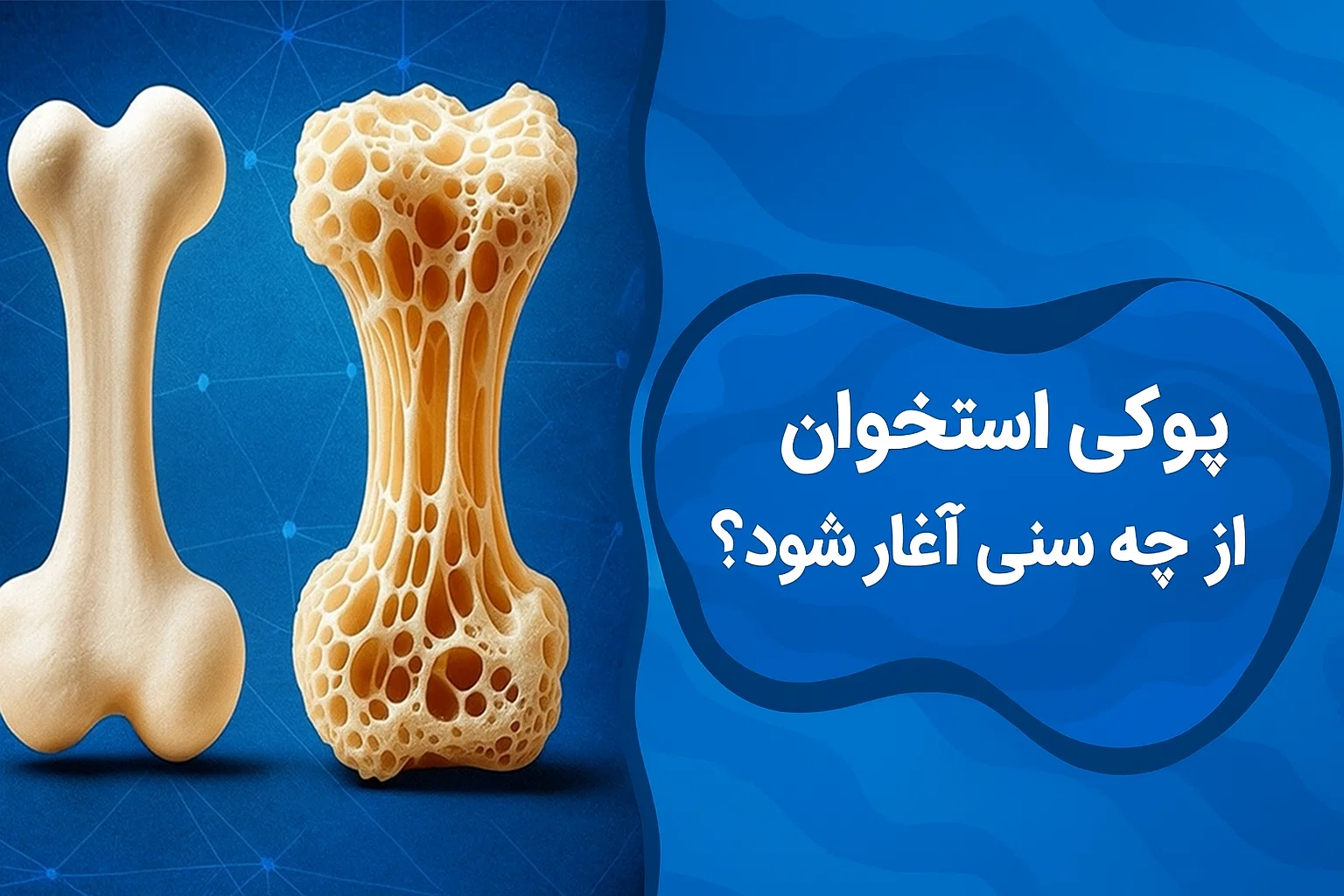 پوکی استخوان از چه سنی آغاز میشود
