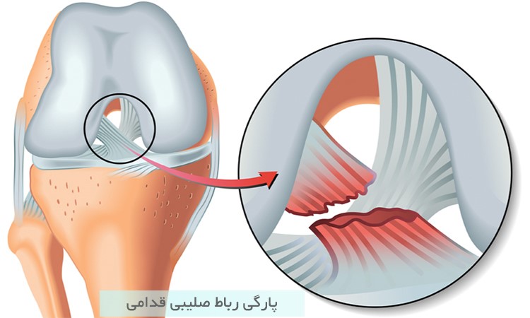 لیگامان صلیبی قدامی