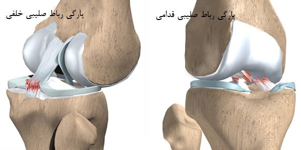 آسیب لیگامان صلیبی قدامی در زانو