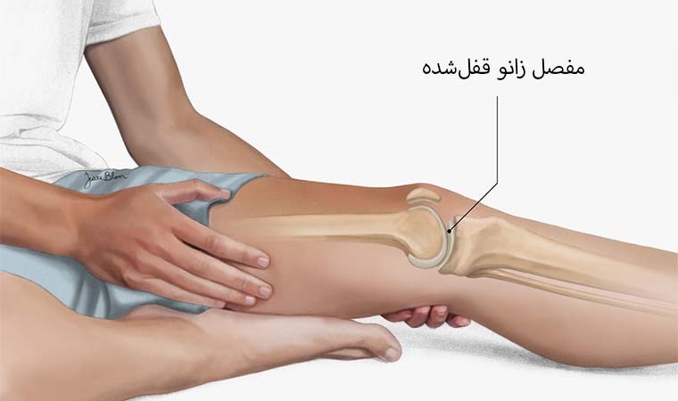 قفل شدن زانو چیست