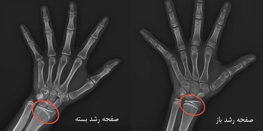 جراحی شکستگی مچ دست