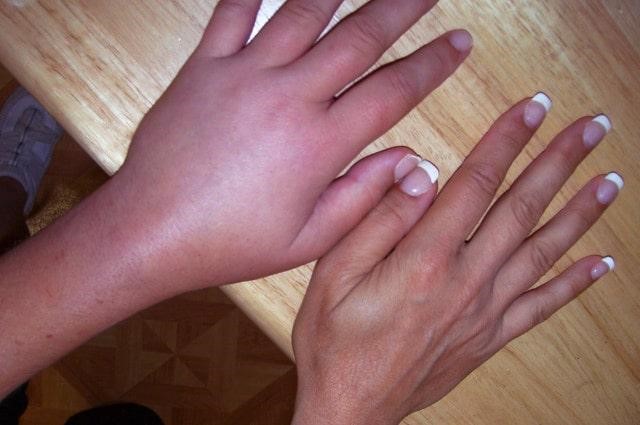 شکستگی‌های خاص