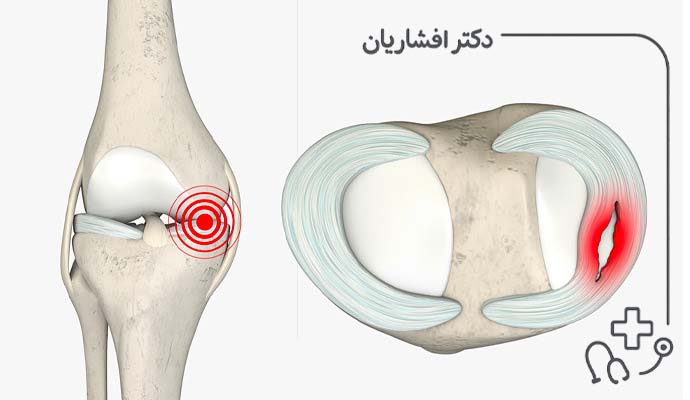 عوامل پارگی منیسک
