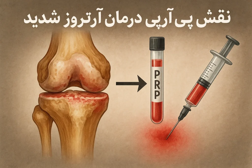 نقش پی آر پی در درمان آرتروز شدید