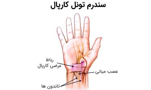 بیماری تونل کارپ