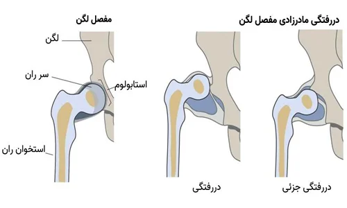 دررفتگی مادرزادی لگن