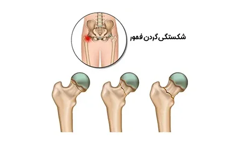 شکستگی گردن استخوان ران
