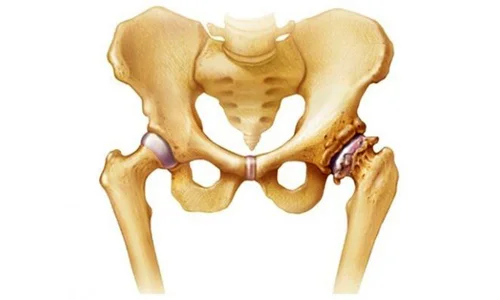 مشکلات استخوان ران