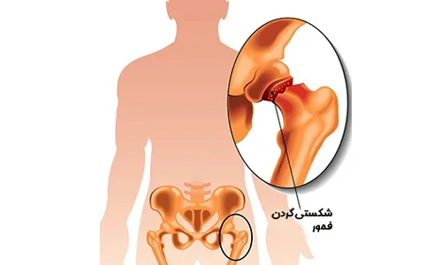 شکست ایمپلنت