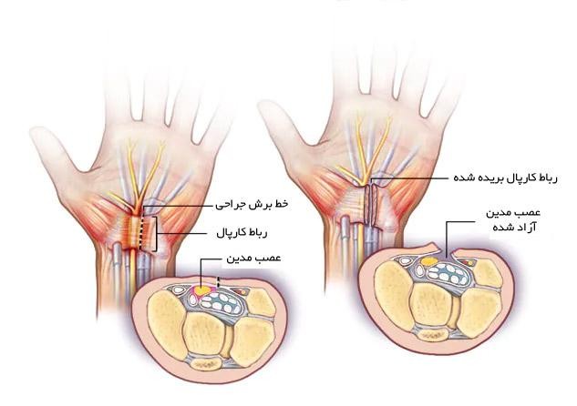 نوار عصب و عضله