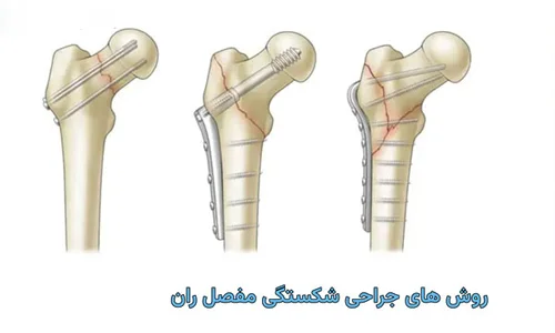 شکستگی گردن ران