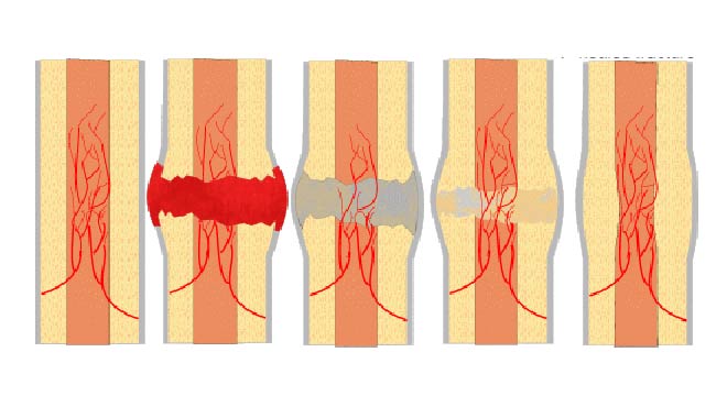 چرا شکستگی گاهی جوش نمی‌خورد؟
