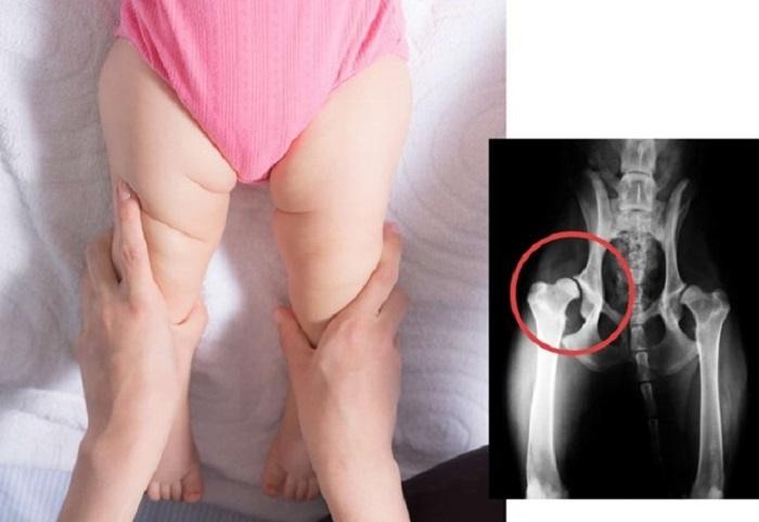 درمان دررفتگی مادرزادی