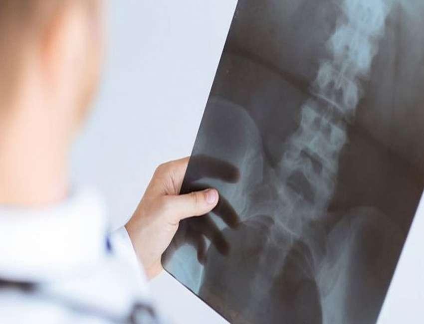 شکستگی گردن