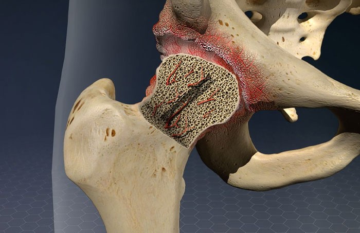 سیاه شدن سر استخوان ؟