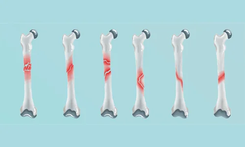 فیزیوتراپی و تمرینات تخصصی