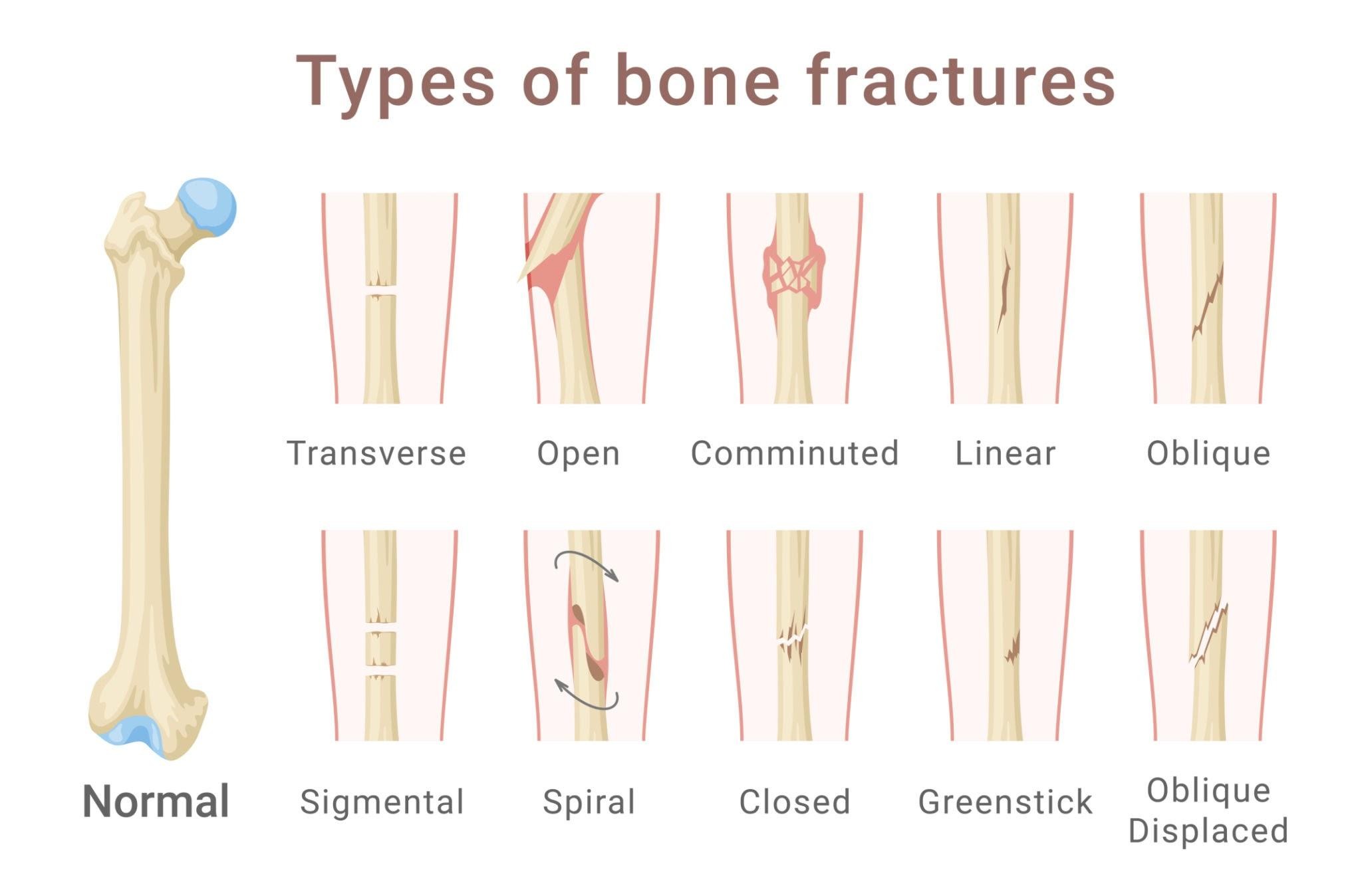 انواع شکستگی تنه