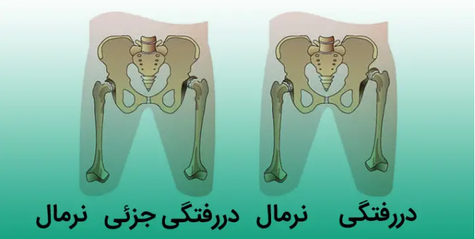 دررفتگی لگن