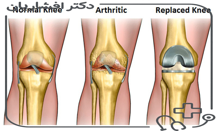 تعویض مفصل زانو