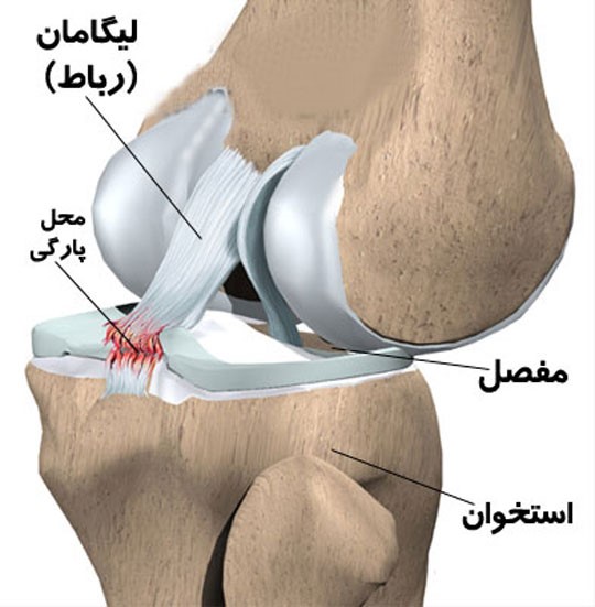 تعویض مفصل زانو در مشهد