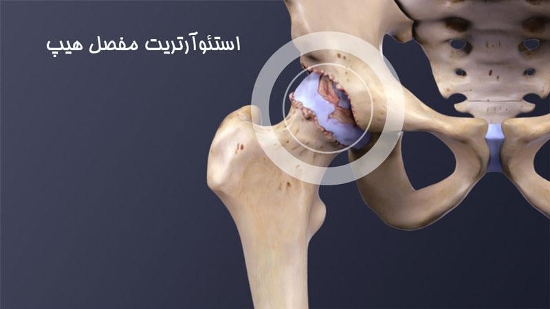 مفصل هیپ کجاست؟