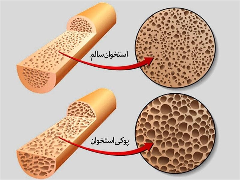 پوکی استخوان