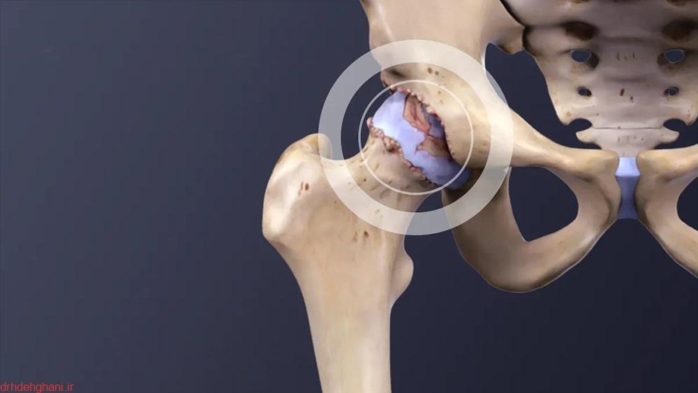 علائم آرتروز لگن