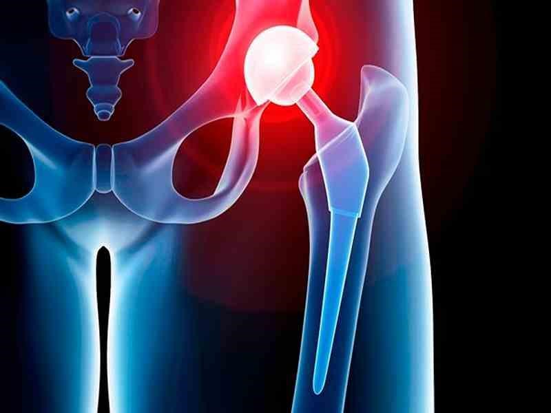 تعویض مفصل ران