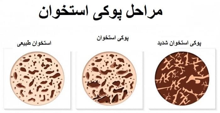 عوارض پوکی استخوان