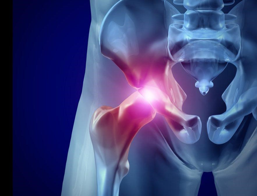 پیشگیری از آرتروز