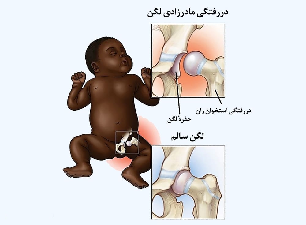 دررفتگی مادرزادی لگن یعنی چه؟