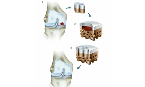 موزائیک پلاستی