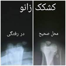 ساختار کشکک