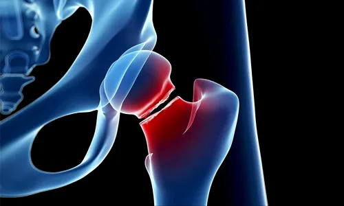 درمان شکستگی گردن