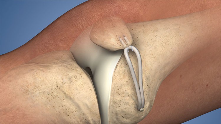 دررفتگی کشکک