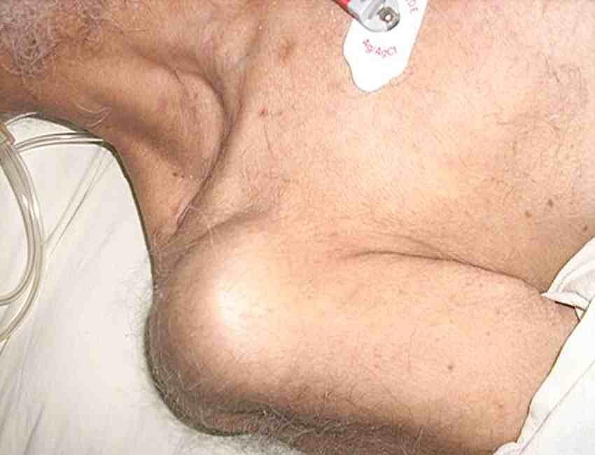 کاهش ریسک دررفتگی شانه