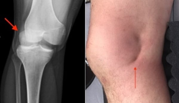 جلوگیری از دررفتگی کشکک