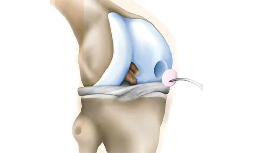 مزیت‌های جراحی موزائیک پلاستی
