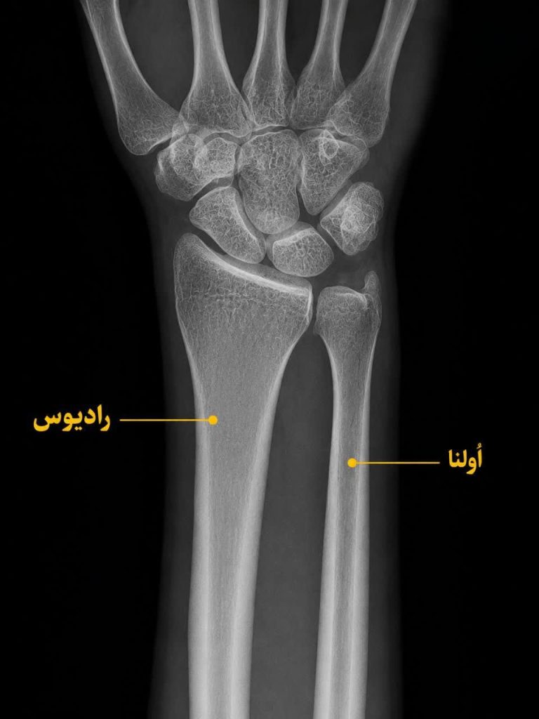 شکستگی مچ دست در بزرگسالان