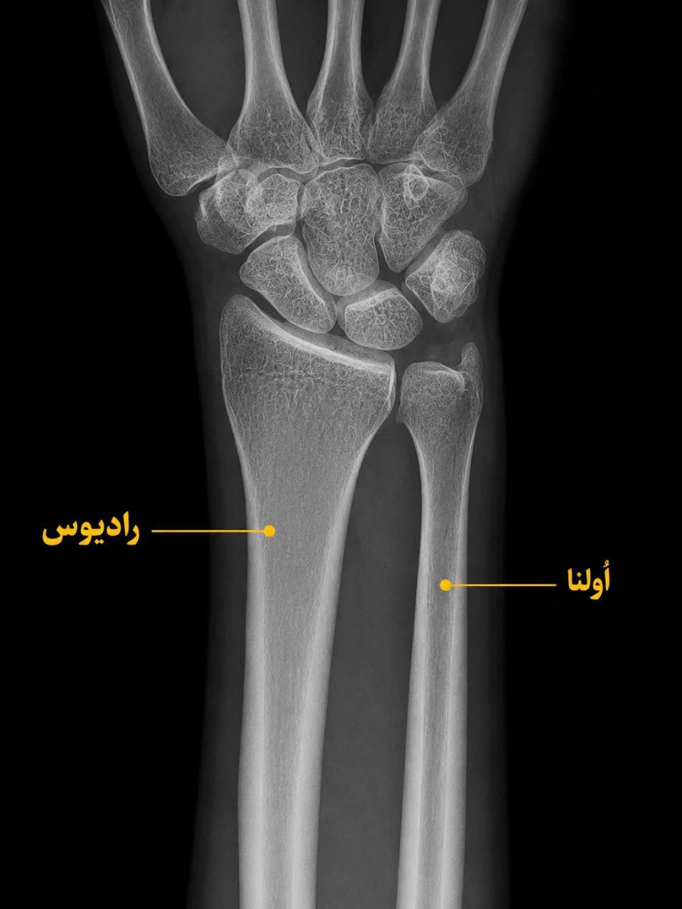 شکستگی مچ دست در بزرگسالان