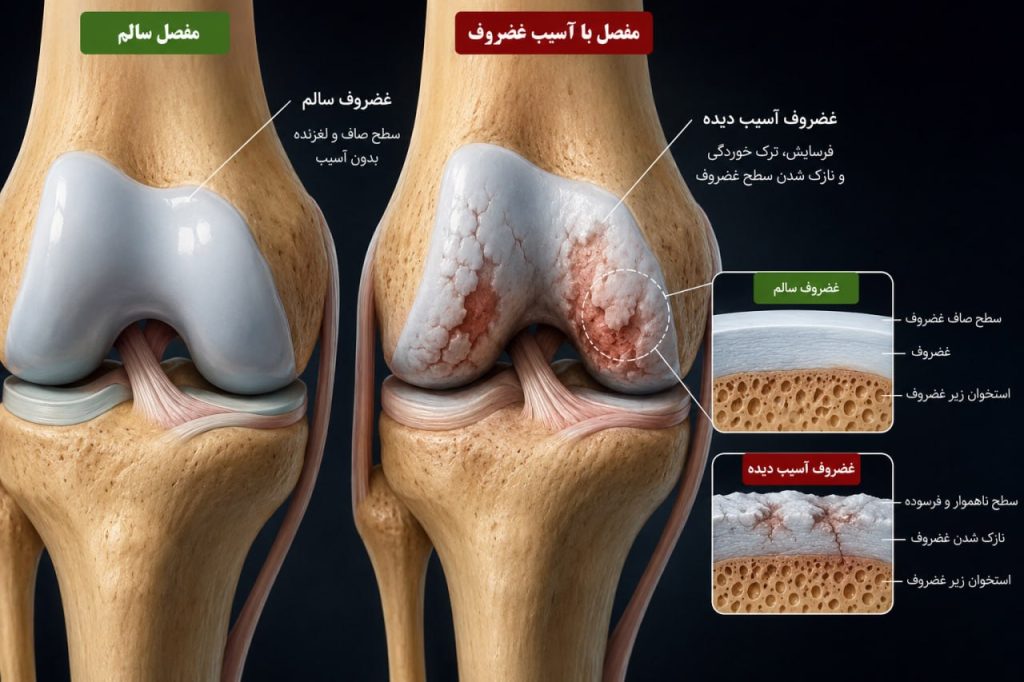 غضروف مفصل چرا آسیب می‌بیند؟