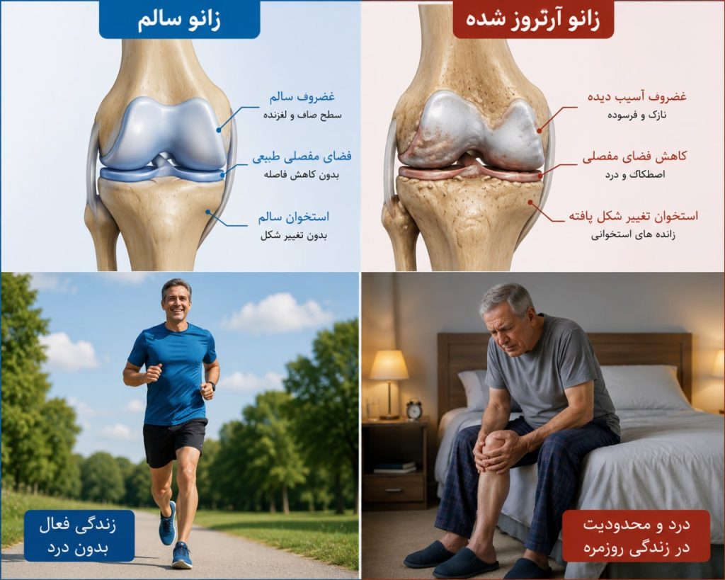 تقسیم‌بندی آرتروز زانو چگونه است؟