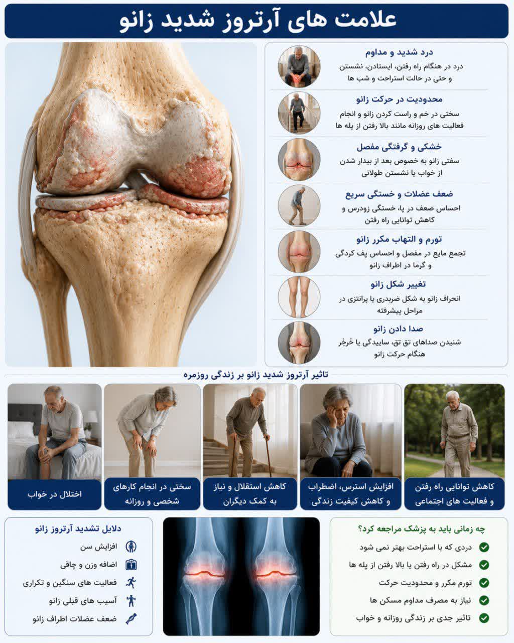 نشانه‌های آرتروز شدید زانو چیست؟