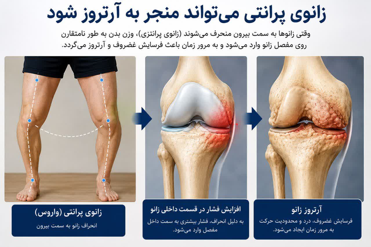 زانوی پرانتزی در بزرگسالان