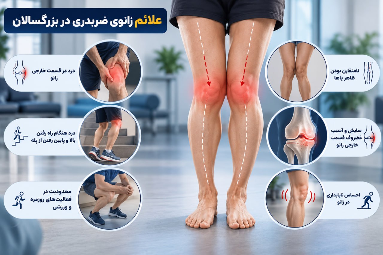 بیماری زانو ضربدری